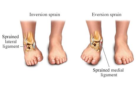 While common, ankle sprains