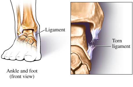 ankle sprain grades